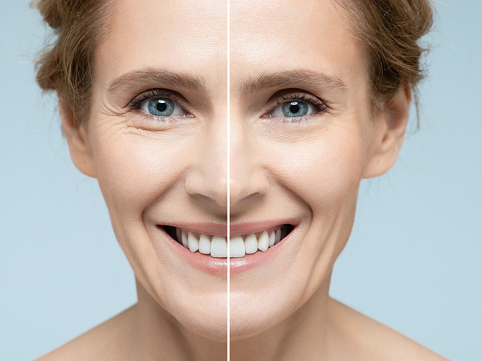 Das Gesicht einer Frau vor und nach Hautstraffungs- und Anti-Aging-Behandlungen. Entfernung von Falten, Nasolabialfalten, Hautverjüngungsbehandlung